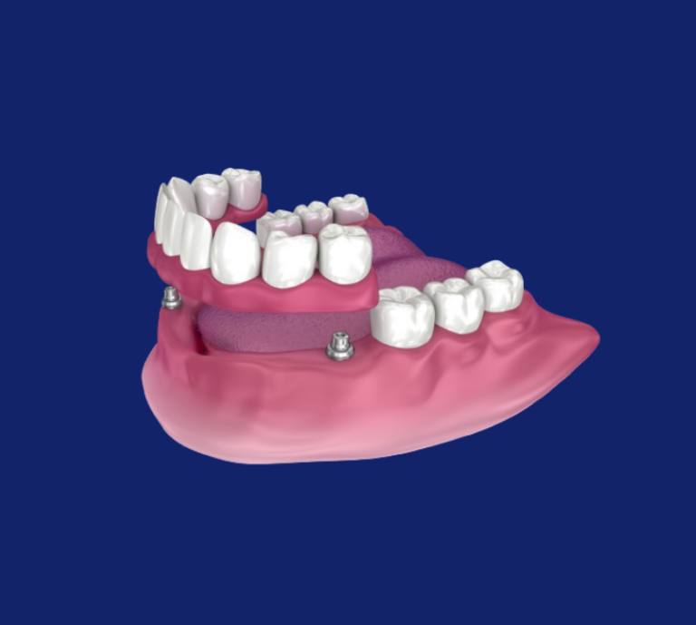 What Are Implant Retained Dentures And How Do They Work